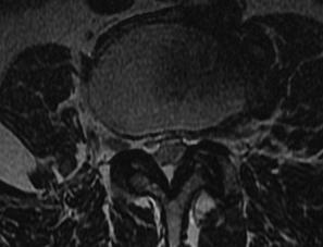 Foraminal Disc 2 MRI